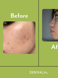 SCANTILY Pad® AM/PM Acne Treatment
